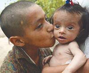 ninodesnutridodelchaco Niño desnutrido de Añatuya, Santiago del Estero, Argentina